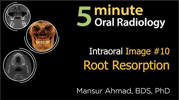 Root Resorption: Intraoral Radiographic Interpretation