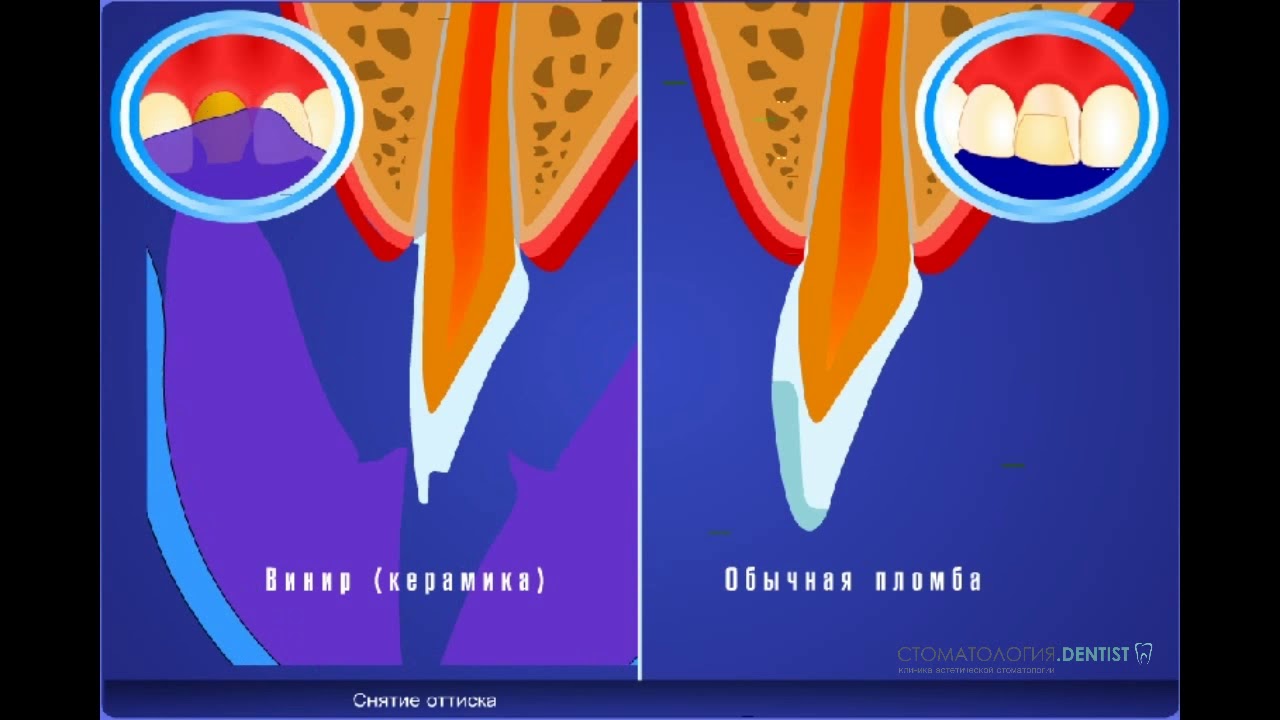 Винир или пломба на зуб? Что лучше ? - YouTube