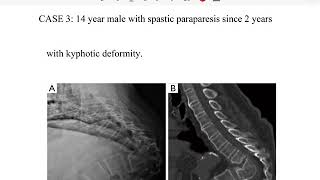 Tubercular Spine series - 8 (late onset paraplegia )