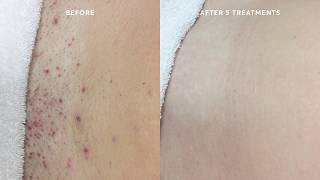 Ingrown Hair Removal Treatment I After Laser Hair Removal