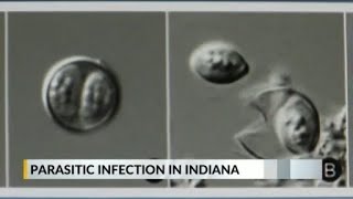‘Can’t really do this anymore’: Patient details experience with diarrhea-causing cyclosporiasis