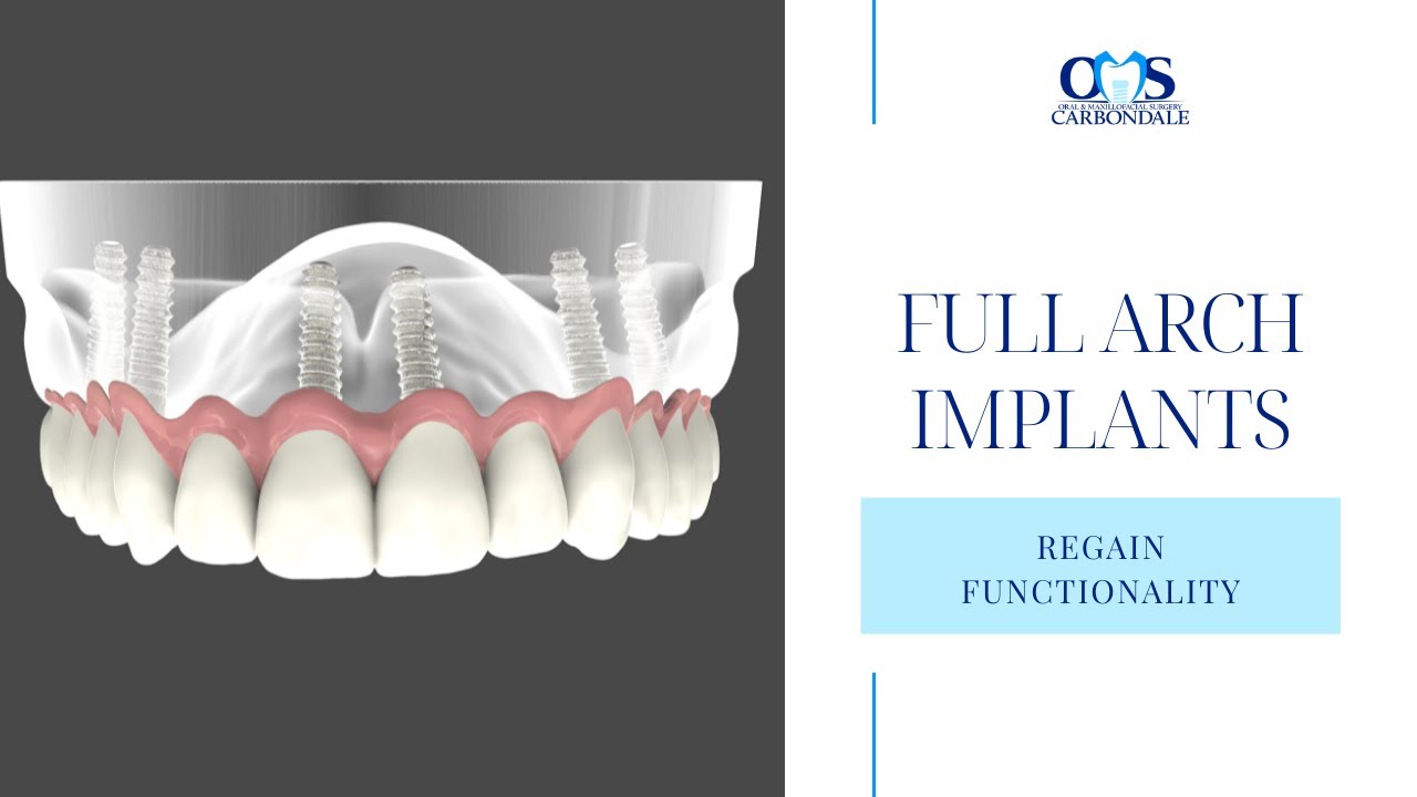 Regain 100% of Your Chewing Ability With Full Arch Dental Implant Restoration