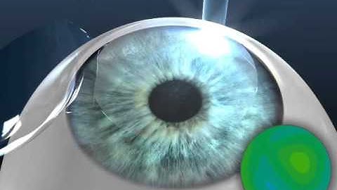 LASIK Eye Surgery: AMO Star S4 IR Excimer Laser Animation