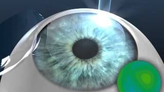 LASIK Eye Surgery: AMO Star S4 IR Excimer Laser Animation Resimi