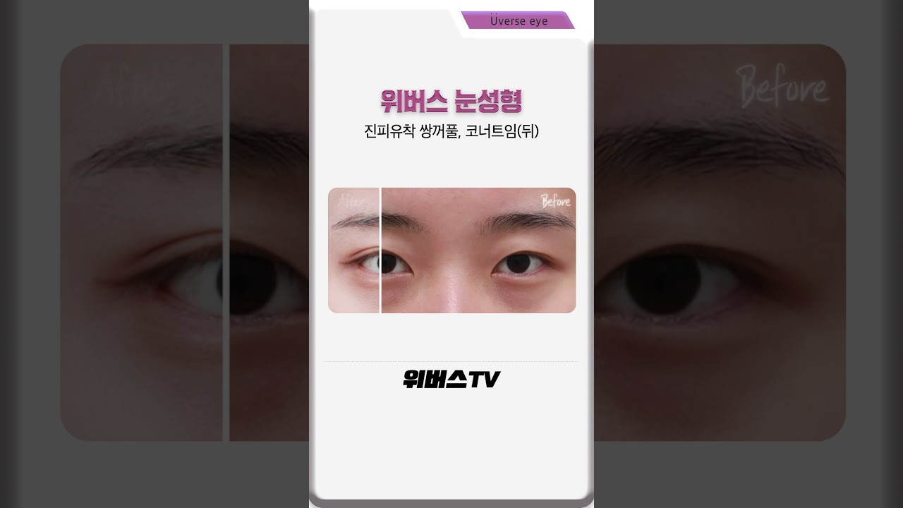 [Вивэрс гоо сайхны мэс заслын эмнэлэг] Давхрагыг тод, үзэсгэлэнтэй болгодог байгалийн наалдац арга 💕