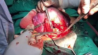 Cesarean delivery \/ c-section : Surgical technique - HD Video