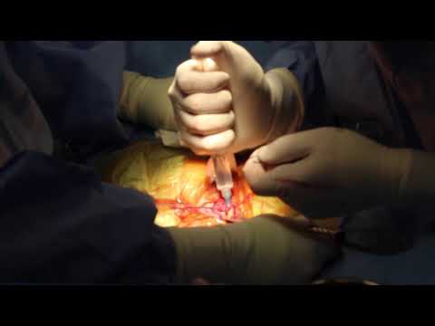 Penile Implant in Man With Radical Prostatectomy No-Touch Atlanta Dr. Hakky