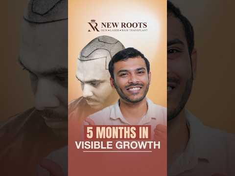 5 Months Results | Cost of Hair Transplant | Hair Transplant in Kolkata #hair #viral #shorts
