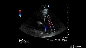 How to...Measure Pulmonary Acceleration Time