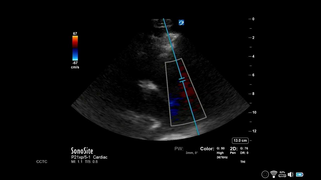 How to...Measure Pulmonary Acceleration Time YouTube