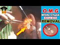 ►Excessive White Earwax - Chunky Earwax Removal from Ear Canal and Eardrum II Best Earwax Extraction