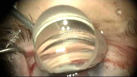 iStent rescue and proper repositioning by Steven G. Safran MD