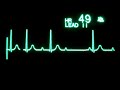 2nd Degree Atrioventricular Block Type I, Mobitz I, Wenckebach.mp4