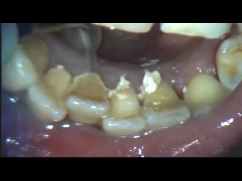 plaque removed dental calculus long overdue plaque calculus teeth