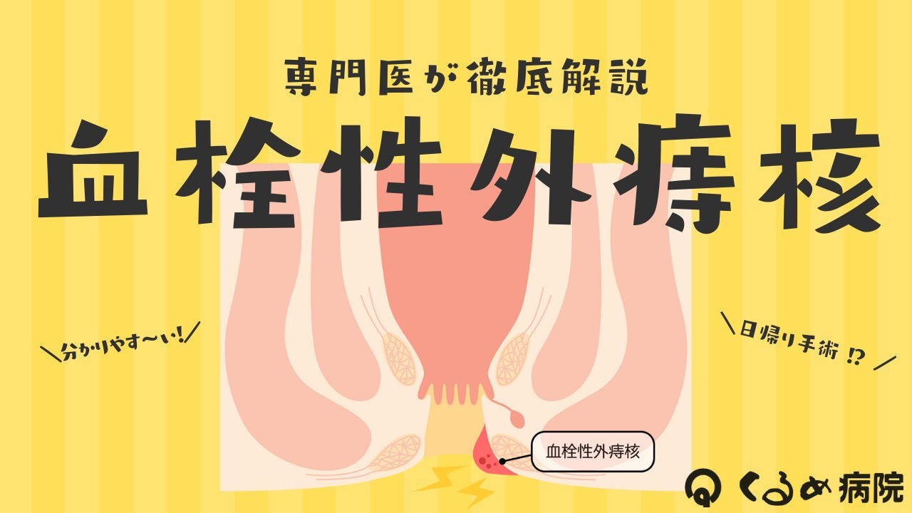 【医師が解説】血栓性外痔核とは?突然痛くなる原因と治療法を院長が説明 - YouTube