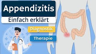 Appendizitis (“Blinddarmentzündung”) - Pathophysiologie, Diagnostik, Symptome, Therapie erklärt