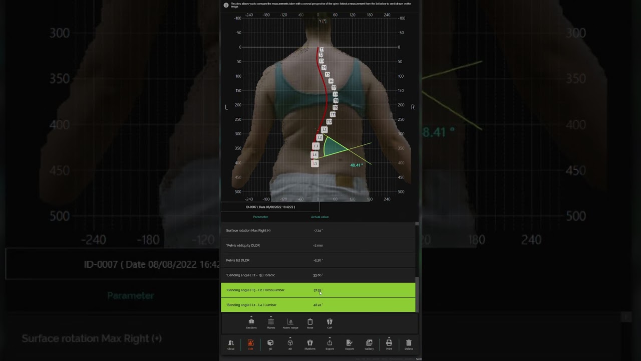 Spine 3D by Sensor Medica. Software Demo: Teenage scoliosis brace patient with high progression risk