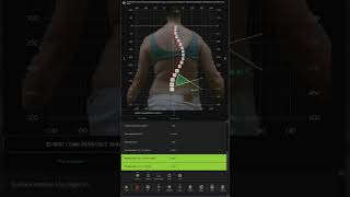 Spine 3D by Sensor Medica. Software Demo: Teenage scoliosis brace patient with high progression risk screenshot 5