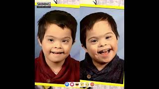 6 Sets of Twins Around the World Who Are Unexpectedly Disabled