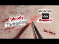 Deep Ingrown Hair Removal ASMR – Raw Tweezing, Blood & Real Extractions