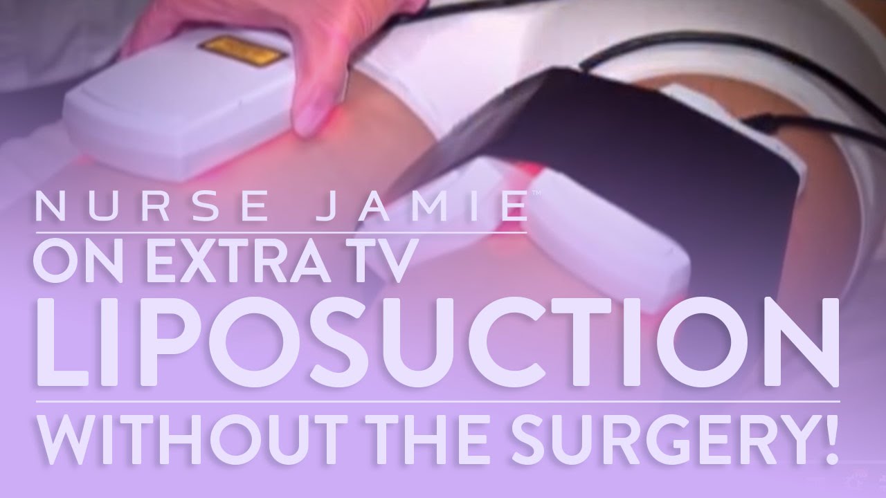 Liposuction Without Surgery! Nurse Jamie on Extra TV YouTube