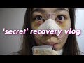 1yr with my new nose! | rhinoplasty recovery vlog