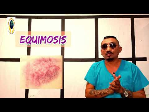 Vídeo: L'equimosi és un signe o símptoma?