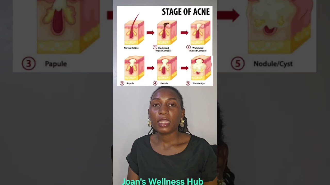 Acne Explained: Types, Causes & What’s Really Happening to Your Skin!