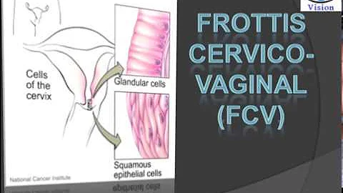 C'est quoi un frottis inflammatoire ?