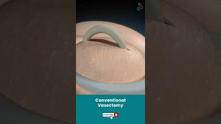 Conventional Vasectomy Surgery ↪ 3D Medical Animation #Shorts #Vasectomy #ConventionalVasectomy