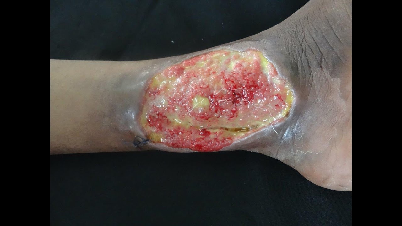 Fin de Úlceras Varicosas en Paciente con Anemia Falciforme 1 de 4 video editing software free