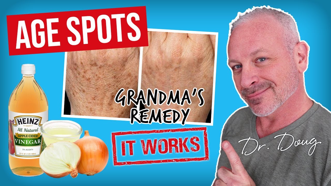Brown Age Spot Remedy Onion Juice And Acv Youtube