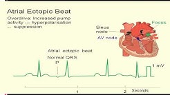 EKG itu Gampang Sesi 3(Aritmia Dasar) - Durasi: 40.44. 