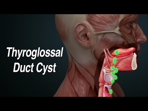 Thyroglossal Duct Cyst (Midline Neck Mass)