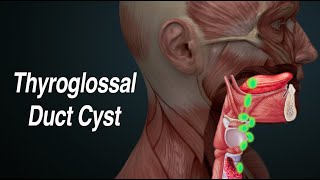 Thyroglossal Duct Cyst (Midline Neck Mass) screenshot 5