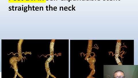 Vascular online training steniting angulated aortic neck in EVAR
