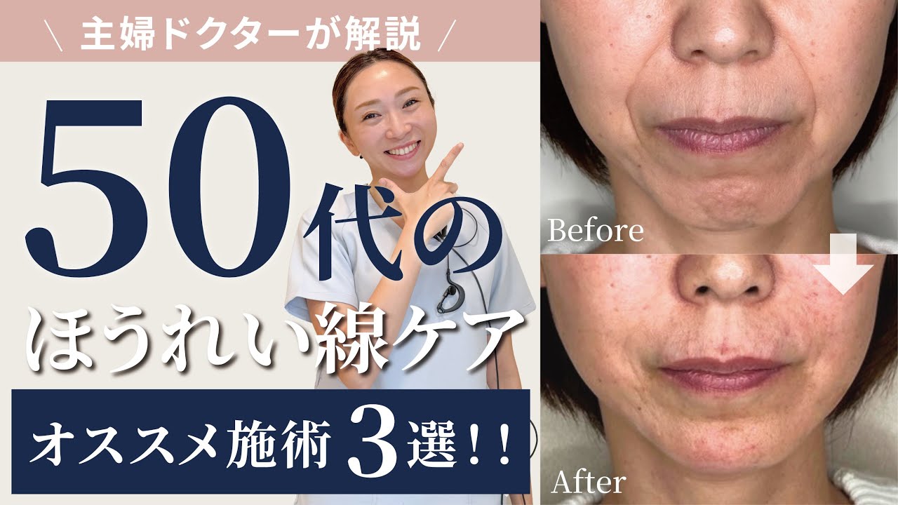 【50代のほうれい線ケア】主婦ドクターが教える！ほうれい線オススメ施術3選！