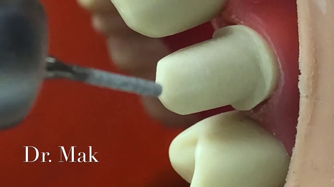 Clinical Tip for your CROWN PREP Task YouTube