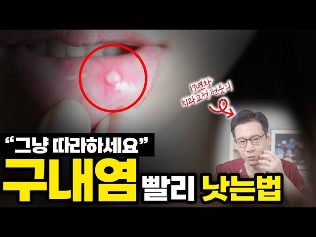 구내염 빨리 낫는 법. 이렇게 하면 당장 통증 멈춥니다!
