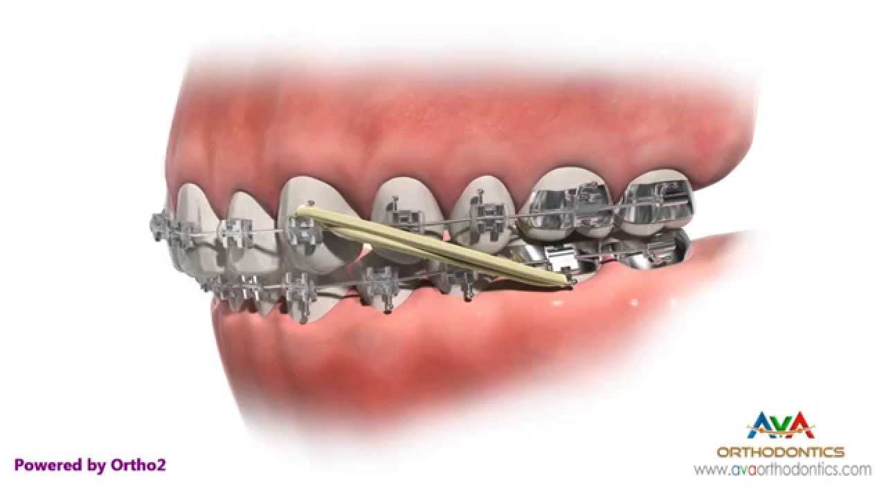 Elastics (Rubber Bands) in Orthodontic Treatment