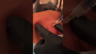 JAW CYST! #cyst #pimplepopper #blackheads #dpow #satisfying #thedoc