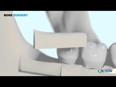 Video: Dokonalé obočie: rys a 3D transplantácia sú v trende