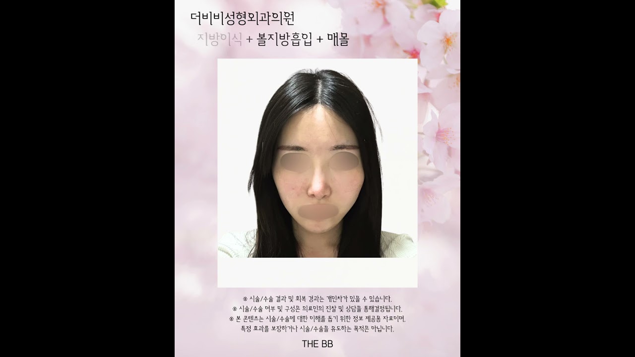 #더비비성형외과 지방이식＋볼지방흡입＋매몰법(se)