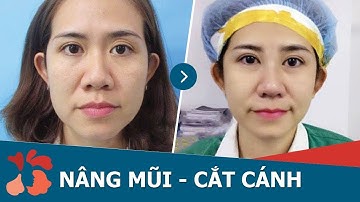 Nâng mũi S Line kết hợp cắt cánh mũi tại BVTM Kangnam