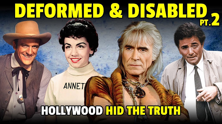 More STRANGE Physical Deformities & Disabilities Of Actors Hollywood Tried to Hide
