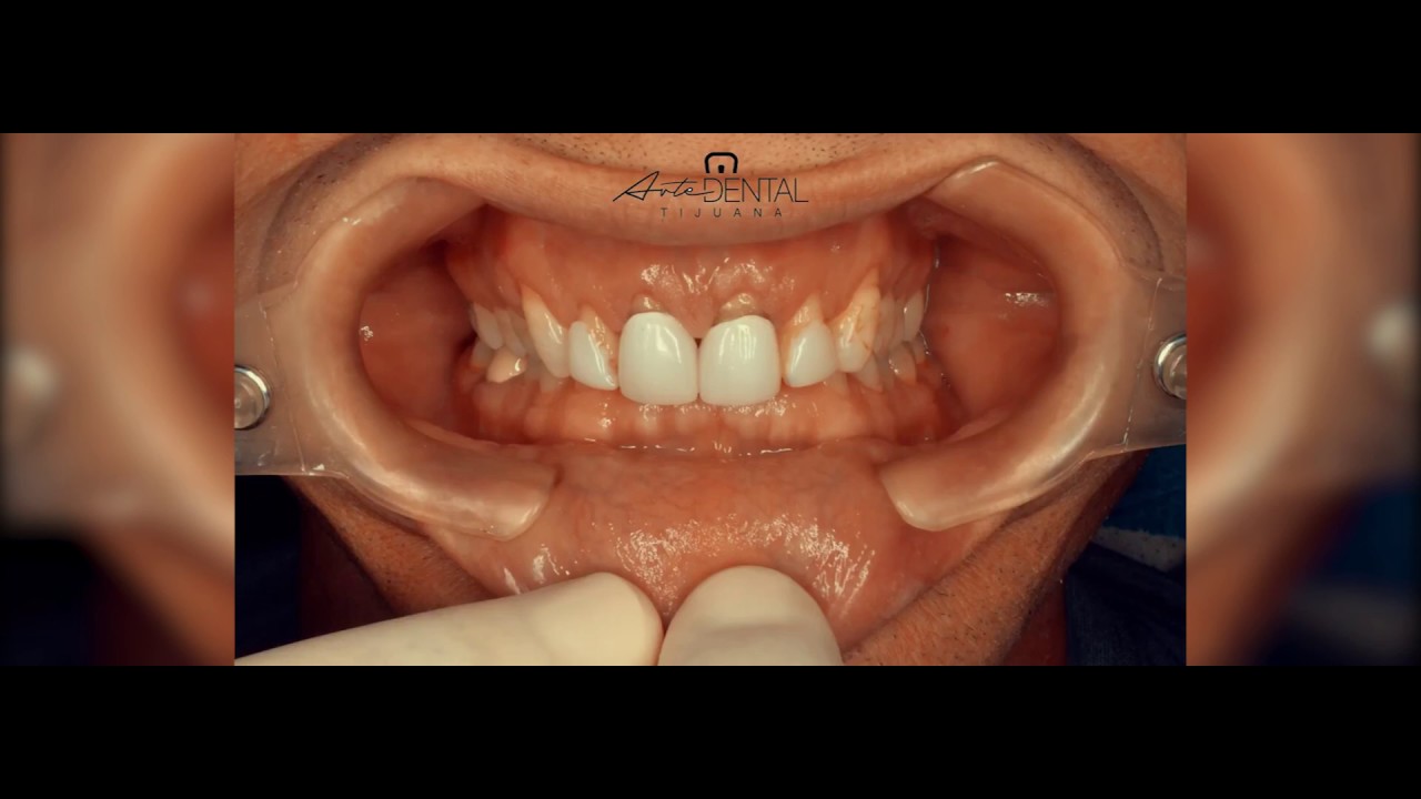 Affordable Dental Implants In Tijuana Mexico Dental Implant Center Tijuana YouTube