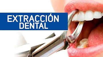 ¿Qué hacer después de una extracción dental con la boca llena?