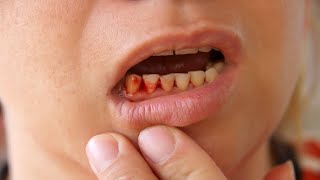 bleeding gum (causes /signs and symptoms/treatment ) #gum #bleeding