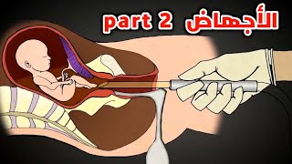 شاهد كيف تحدث عملية الأجهاض الجزء الثاني_ surgical abortion part 2