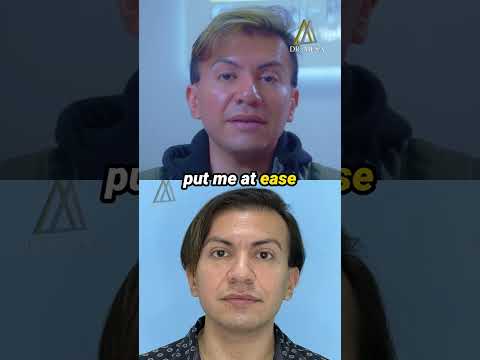 Buccal fat removal patient testimonial, real patient experience with Dr. John Mesa